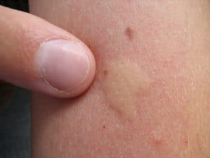alergia-a-picaduras-de-mosquitos-5