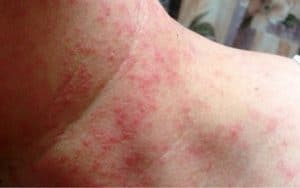 alergia a piquetes de mosco