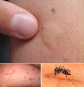 alergias por picaduras de insectos 1