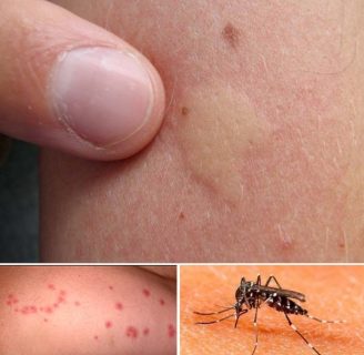 Descubre lo que puedes hacer en caso de alergias por picaduras de insectos