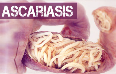 ascariasis