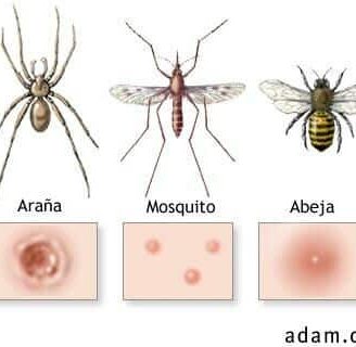 Picaduras de insectos: Enfermedades, síntomas, tratamiento y más.